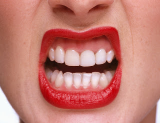 Close-up of a person with red lipstick, gritting their teeth, showing uneven and misaligned dental alignment—a stark contrast to the serene ambiance of Josephine's Day Spa.