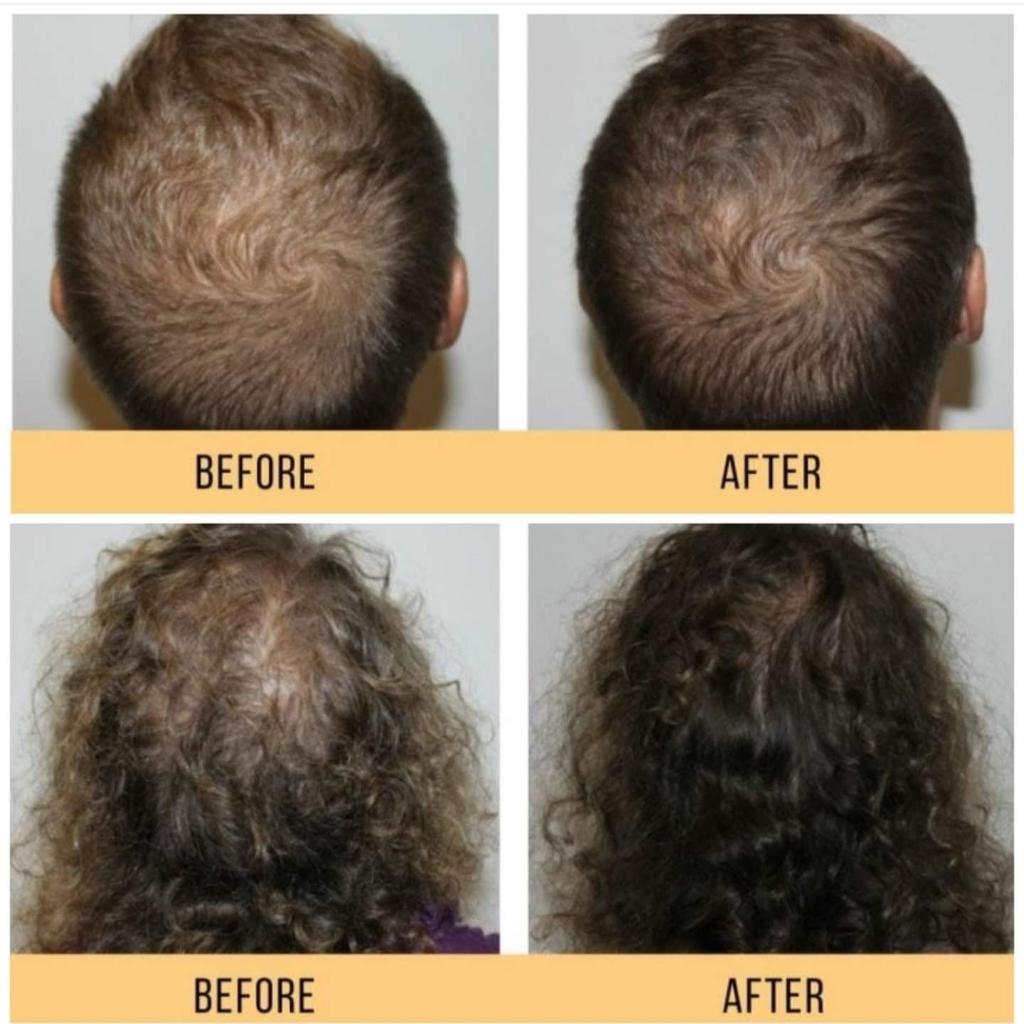 Improve Your Scalp Heath with HydraFacial Keravive Josephine's Day Spa Houston, TX