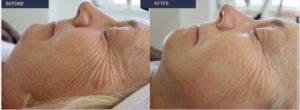 Before and after treatment at luxury Aveda salon in Houston, TX: reduced wrinkles, smoother skin, radiant complexion. | Josephine's Salons and Spas | Houston, TX