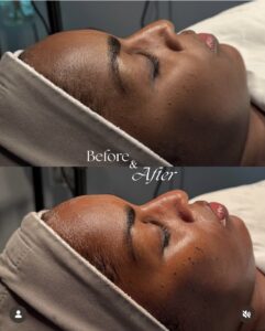 Before & After: Side-by-side images at a Houston luxury Aveda salon and spa show facial treatment results—skin looks smoother, more radiant, and rejuvenated. | Josephine's Salons and Spas | Houston, TX