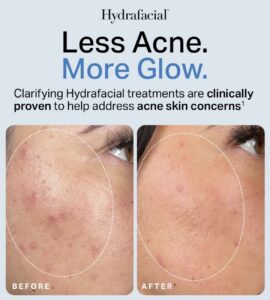 Close-up side-by-side of a client’s cheek at a luxury Aveda salon in Houston: before Hydrafacial with acne, after Hydrafacial with clearer, smoother skin. | Josephine's Salons and Spas | Houston, TX